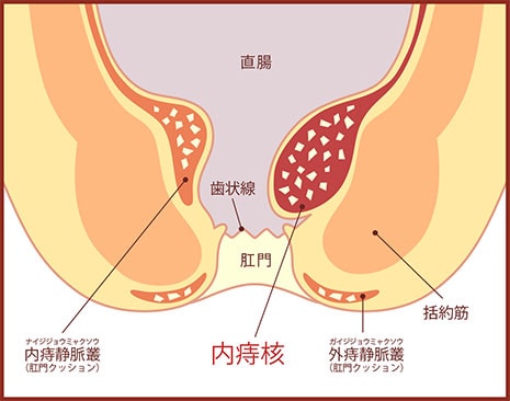 内痔核の図