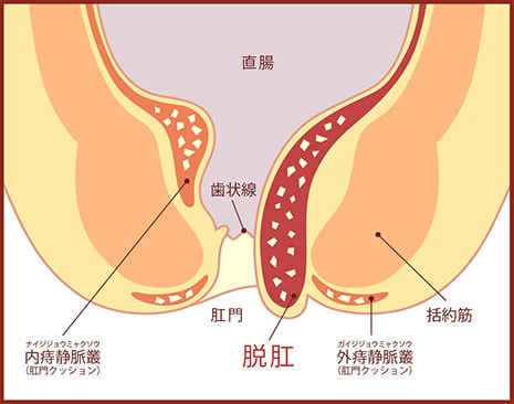 切れ 痔 治し 方