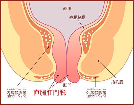 直腸肛門脱の図