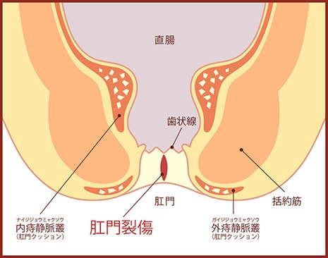 肛門裂傷の図