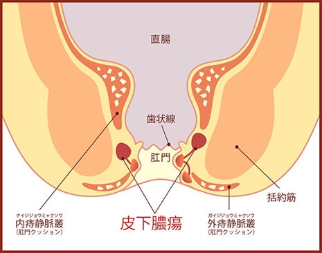 皮下膿瘍の図
