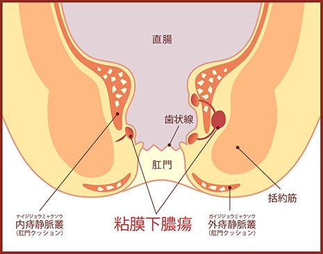 粘膜下膿瘍の図