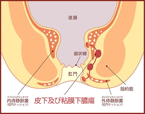 皮下及び粘膜下膿瘍の図