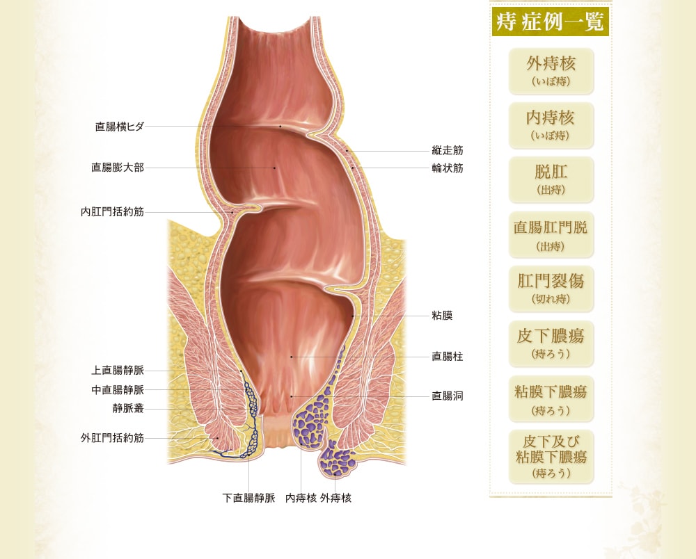 痔症例一覧 外痔核（いぼ痔）/内痔核（いぼ痔）/脱肛（出痔）/直腸肛門脱（出痔）/肛門裂傷（切れ痔）/皮下膿瘍（痔ろう）/粘膜下膿瘍（痔ろう）/皮下及び粘膜下膿瘍（痔ろう）