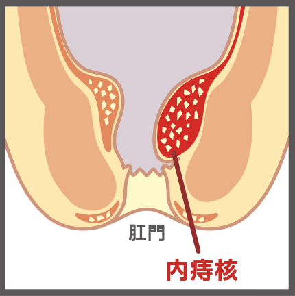 内痔核