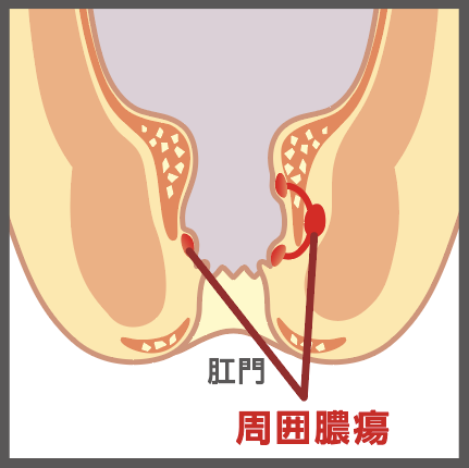 周囲膿瘍