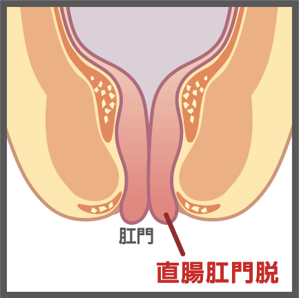 直腸肛門脱